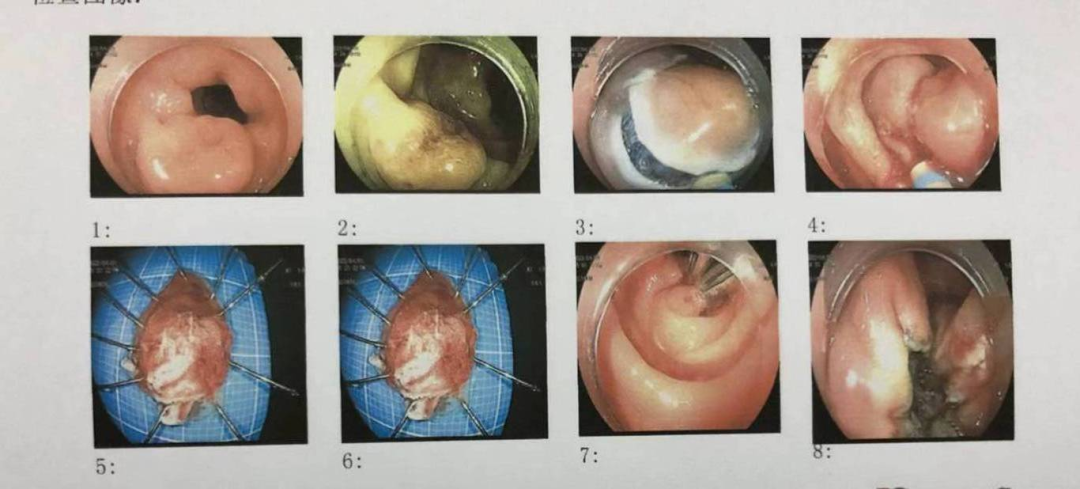 苍南县中医院成功开展消化道早癌的内镜下治疗