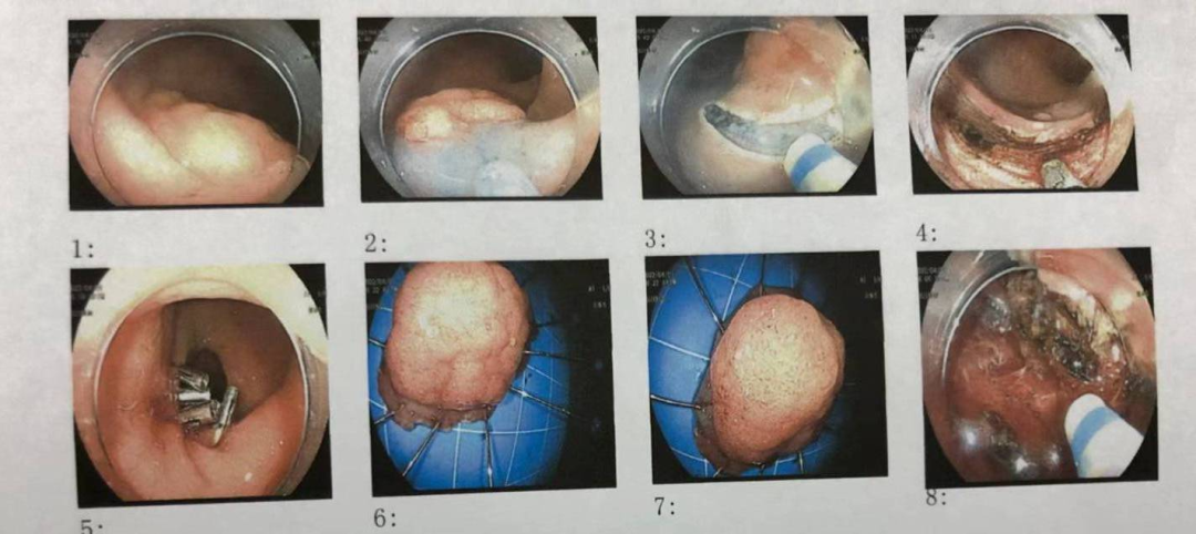 苍南县中医院成功开展消化道早癌的内镜下治疗