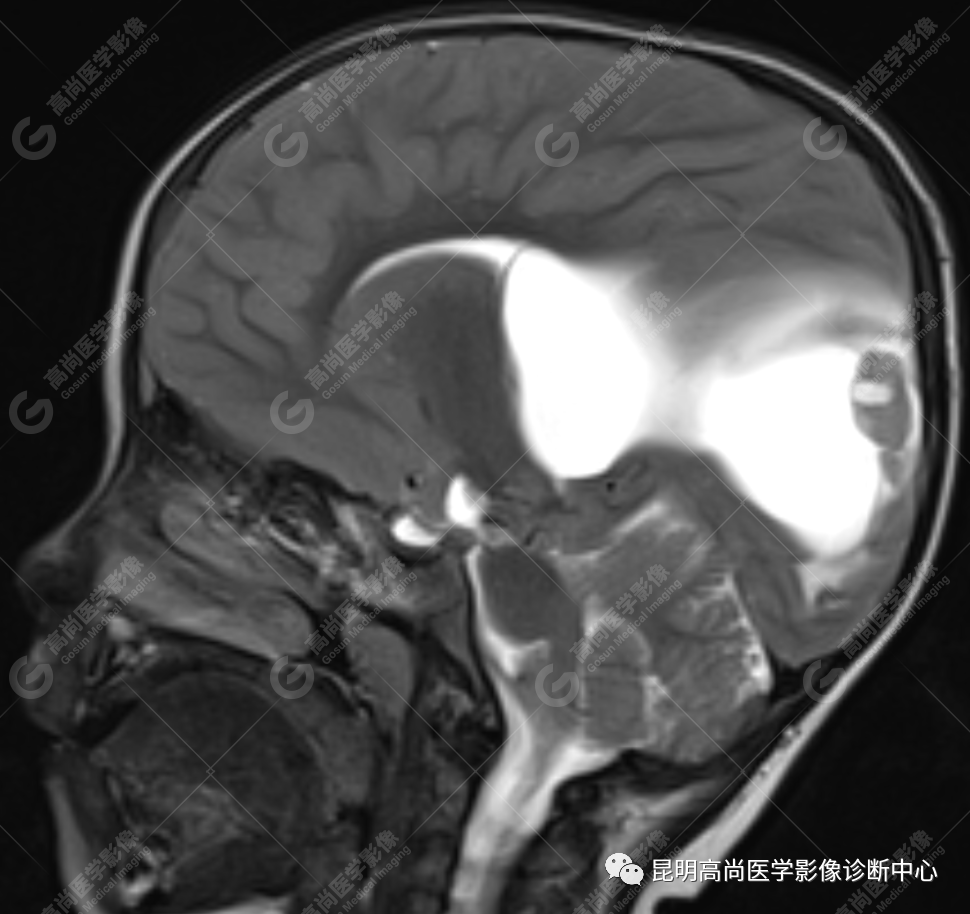 高尚病例：侧脑室三角区室管膜瘤一例
