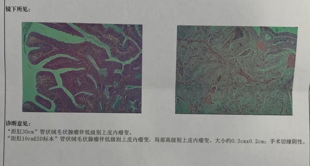 苍南县中医院成功开展消化道早癌的内镜下治疗