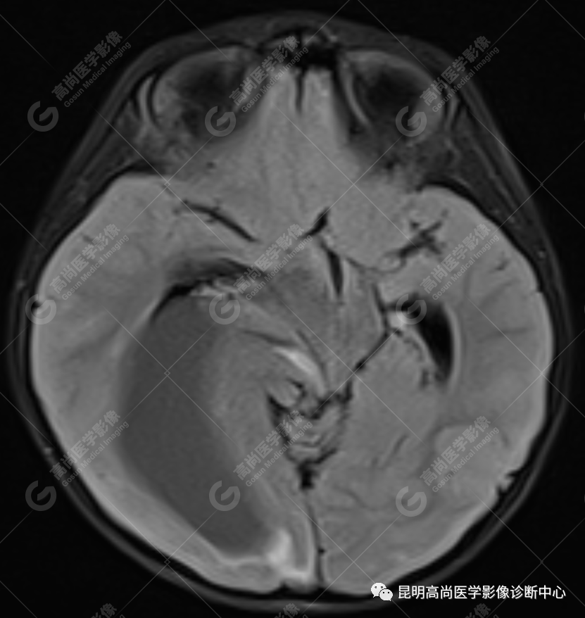 高尚病例：侧脑室三角区室管膜瘤一例
