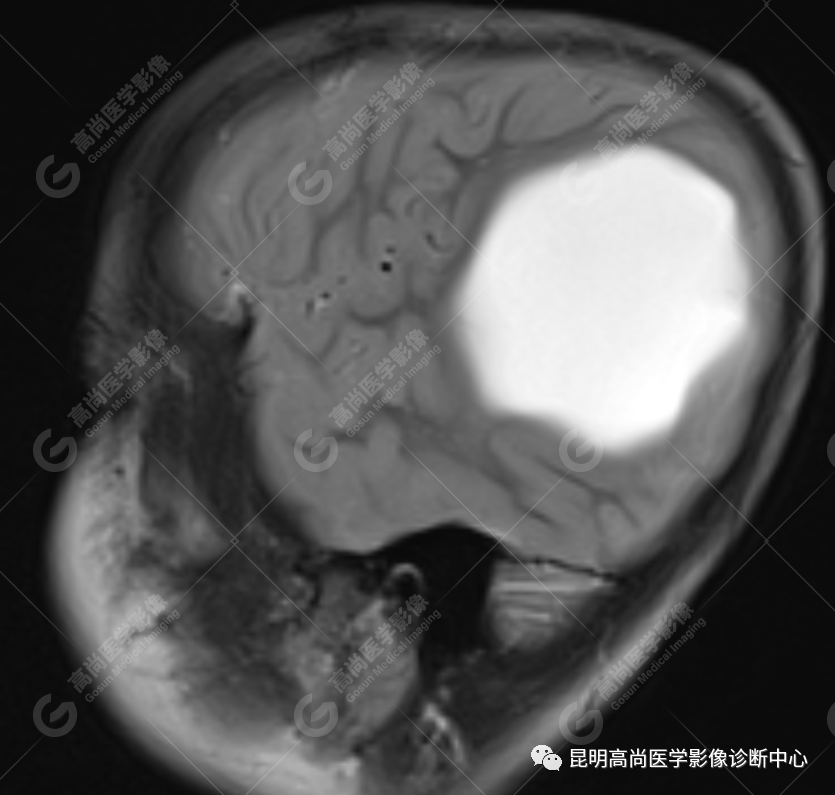 高尚病例：侧脑室三角区室管膜瘤一例