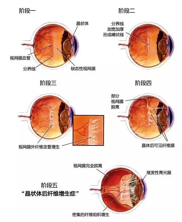 3 个月宝宝眼看要失明！深圳市眼科医院开绿色通道，800 公里光明接力