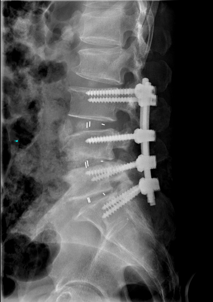苏州京东方医院骨科成功完成一例多节段腰椎管狭窄合并马尾神经损伤手术