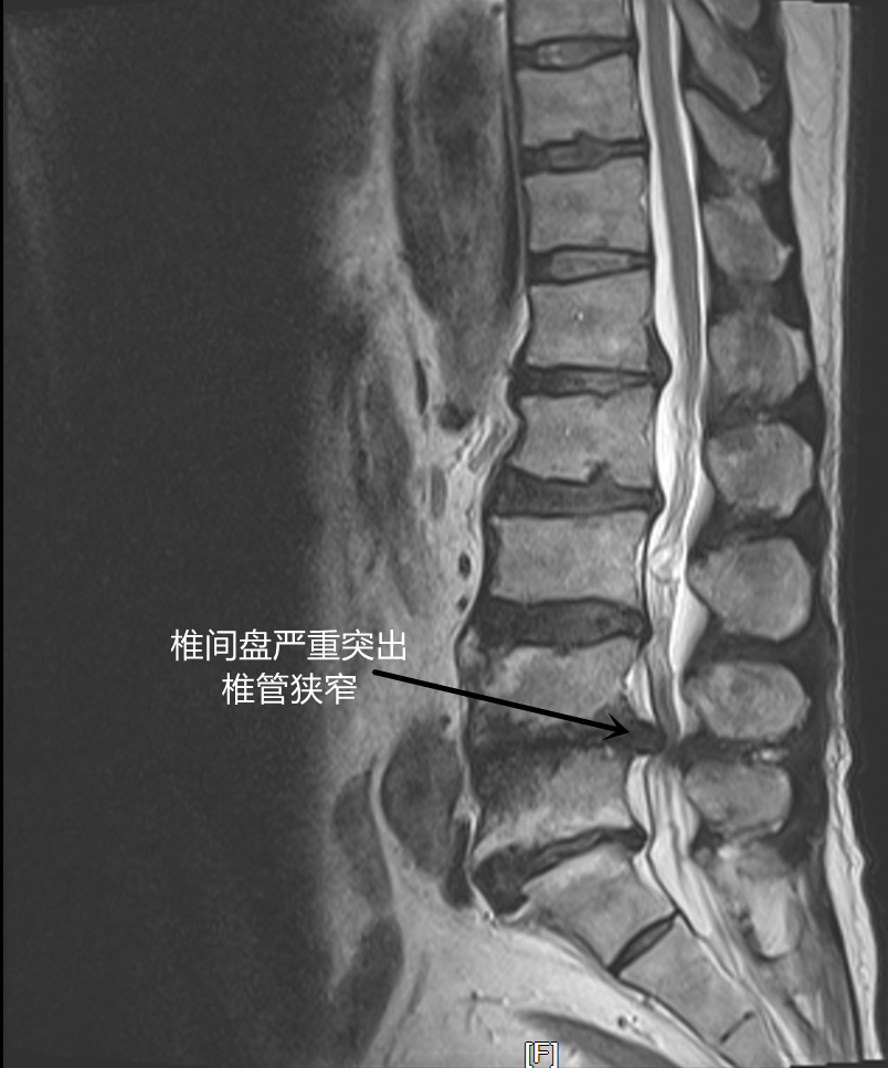 苏州京东方医院骨科成功完成一例多节段腰椎管狭窄合并马尾神经损伤手术