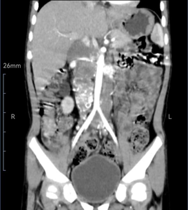 与死神抗争,在刀尖上跳舞,多学科协作救治 5 岁患癌男孩