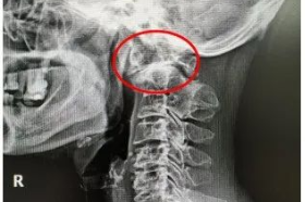 桂林医学院附属医院脊柱外科实施寰枢椎手术，解除困扰患者长达 6 年的病痛