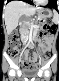 与死神抗争,在刀尖上跳舞,多学科协作救治 5 岁患癌男孩