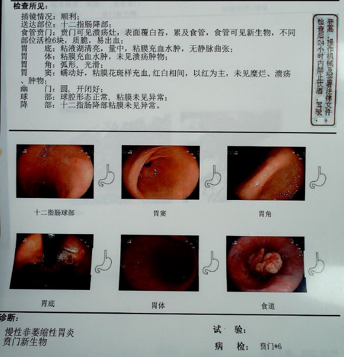 高尚案例 贲门癌一例