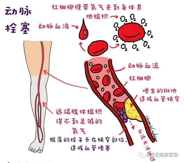 疫情期间，那些等不得的血管病急症