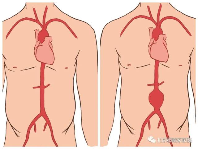 疫情期间，那些等不得的血管病急症
