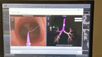 快速、精准、无痛定位肺部小结节——气管迷宫里的「GPS」