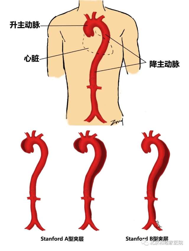 疫情期间，那些等不得的血管病急症