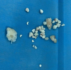 关节内闹「鼠患」,徐州仁慈医院关节镜下大扫除