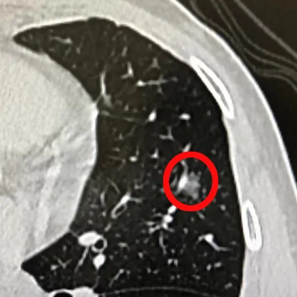 快速、精准、无痛定位肺部小结节——气管迷宫里的「GPS」