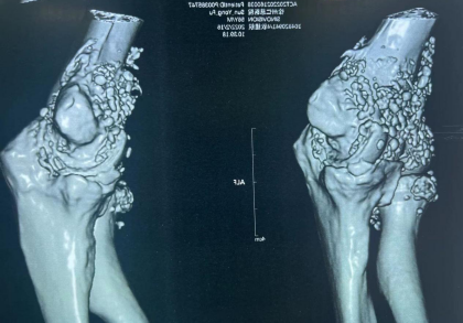 关节内闹「鼠患」,徐州仁慈医院关节镜下大扫除