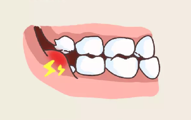 在智齿即将破龈而出的那段时间