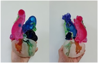 武汉亚洲心脏病医院 3D 打印技术——「私人订制」的心血管手术