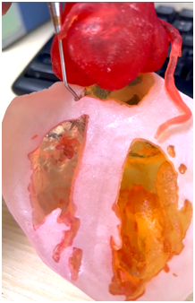 武汉亚洲心脏病医院 3D 打印技术——「私人订制」的心血管手术