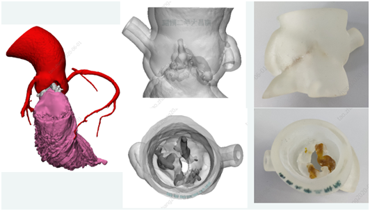 武汉亚洲心脏病医院 3D 打印技术——「私人订制」的心血管手术