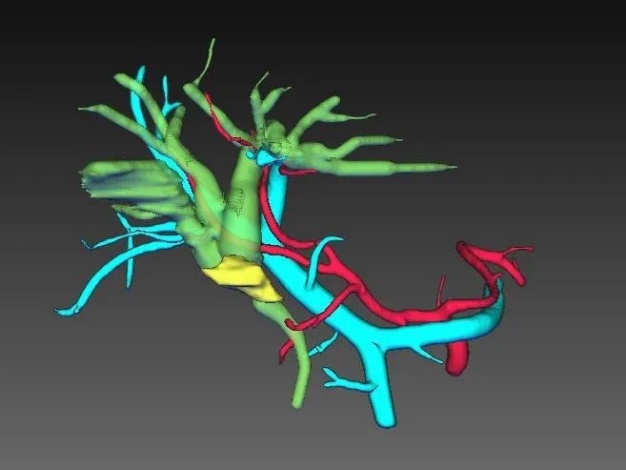 84 岁老人一周内变身「小黄人」，多并发症情况下完成肝门部胆管癌根治手术