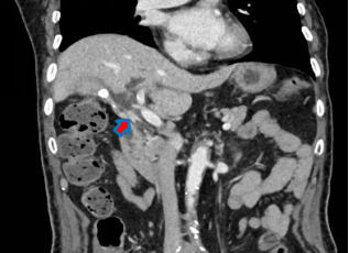 84 岁老人一周内变身「小黄人」，多并发症情况下完成肝门部胆管癌根治手术