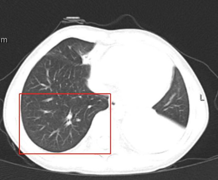 孩子发烧 1 天转入重症病房，发烧怪兽这样对抗！