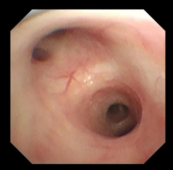 孩子发烧 1 天转入重症病房，发烧怪兽这样对抗！