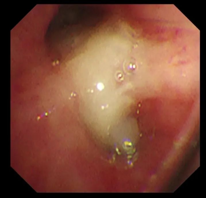孩子发烧 1 天转入重症病房，发烧怪兽这样对抗！