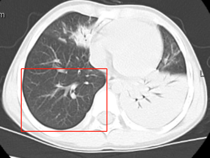 孩子发烧 1 天转入重症病房，发烧怪兽这样对抗！