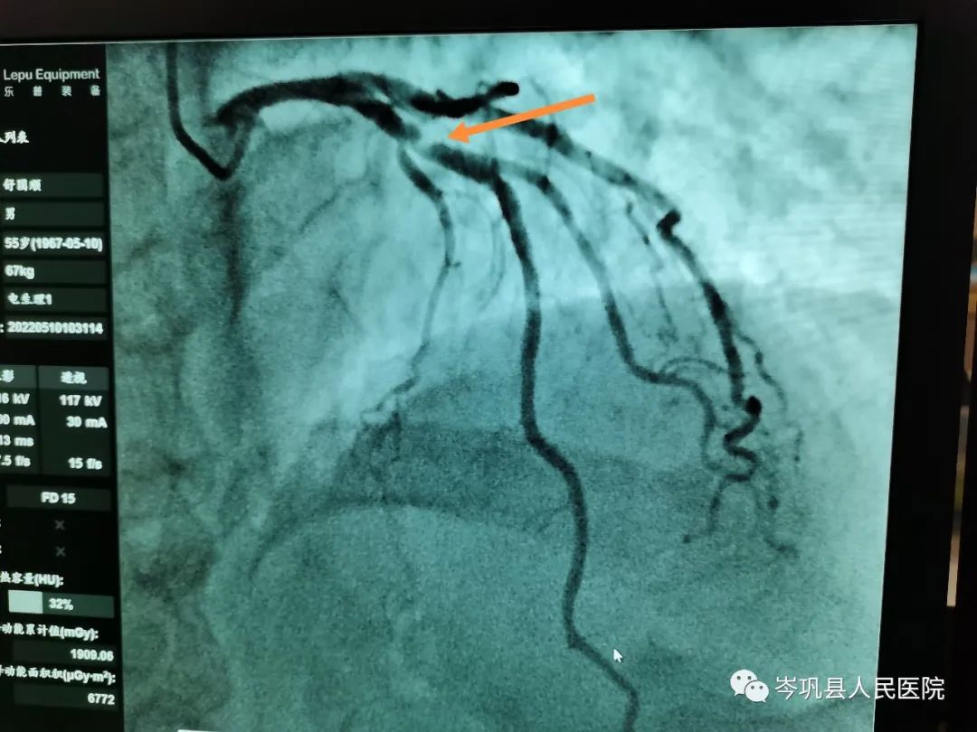 帮扶新技术，介入无植入——人医帮扶医生带领岑巩县人民医院心内科开展首例生物可吸收冠脉支架植入术