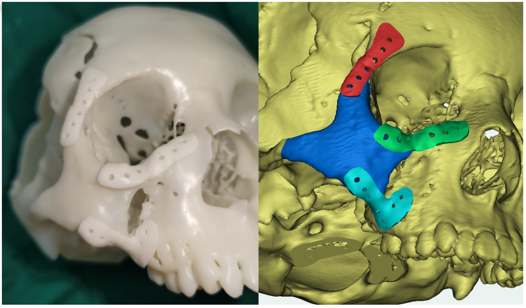 精准还原 10 岁女孩「妈生脸」！计算机建模+3D 打印「真香了」
