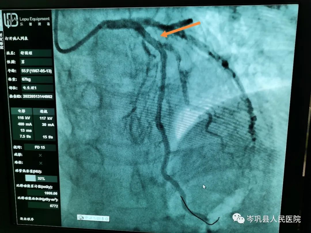 帮扶新技术，介入无植入——人医帮扶医生带领岑巩县人民医院心内科开展首例生物可吸收冠脉支架植入术