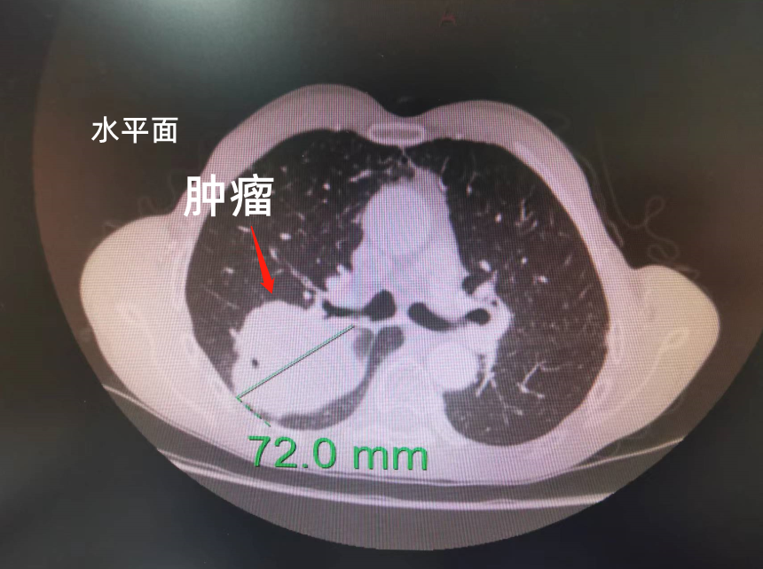 九江市第一人民医院胸心外科再次采用单孔胸腔镜完成一例高难度肺癌袖式切除