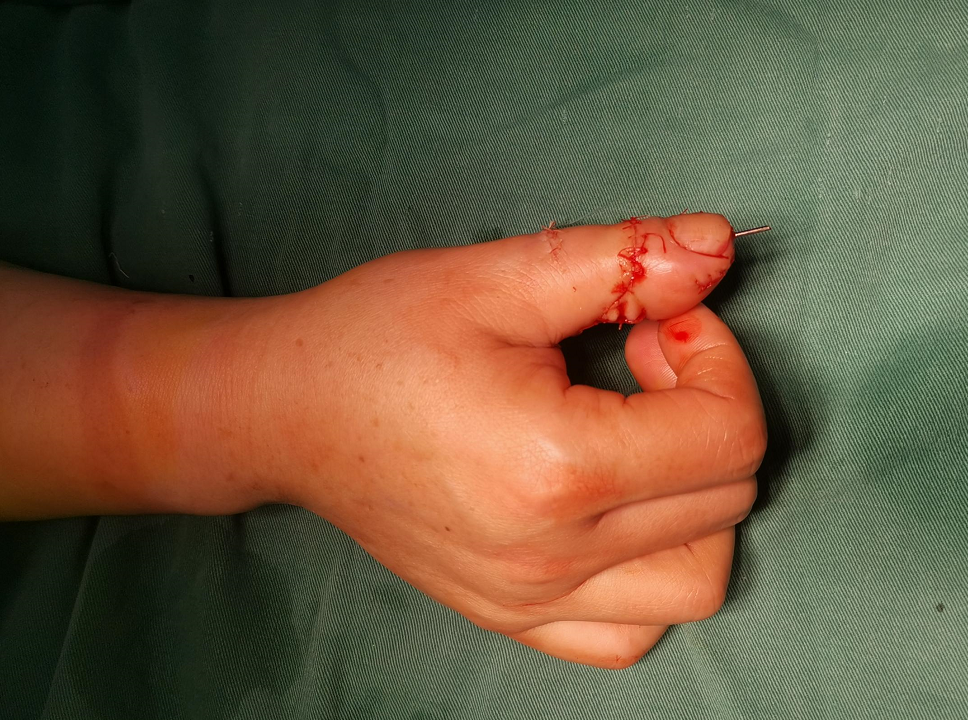 一截手指,跨越了 30 年的痛苦折磨!