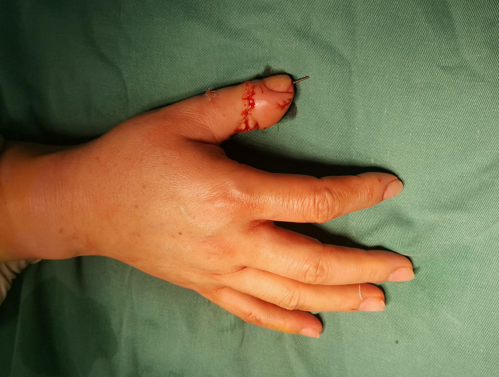 一截手指,跨越了 30 年的痛苦折磨!