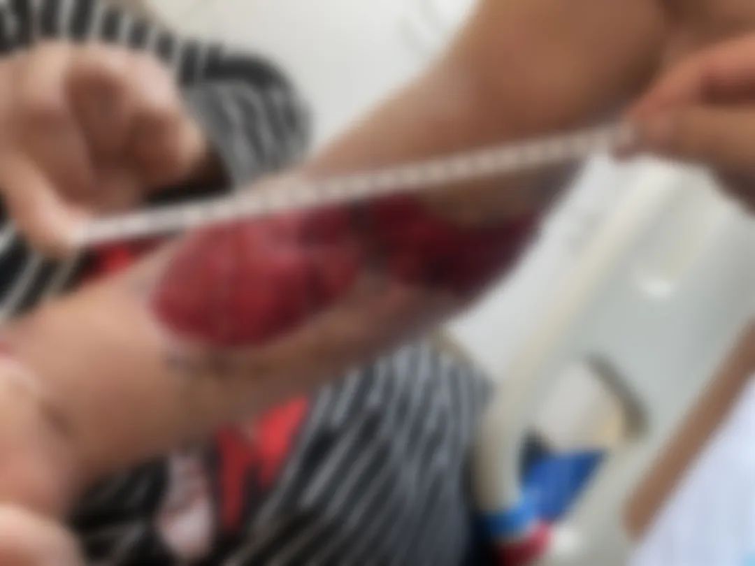 危急！男子手臂被两吨钢板砸中，手臂粉碎性骨折！