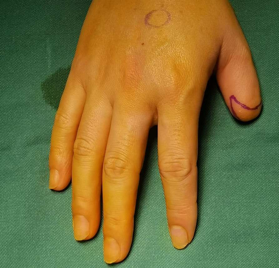 一截手指,跨越了 30 年的痛苦折磨!