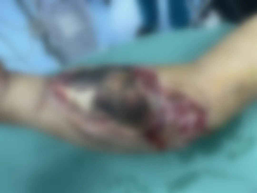 危急！男子手臂被两吨钢板砸中，手臂粉碎性骨折！