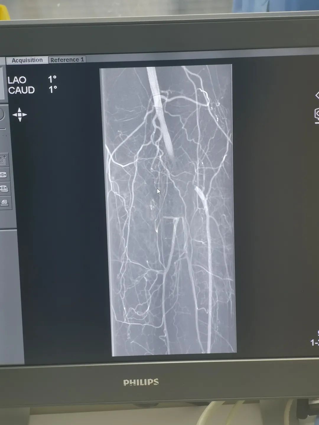 北京中医医院顺义医院疮疡血管外科成功完成首例下肢动脉球囊扩张、置管溶栓术
