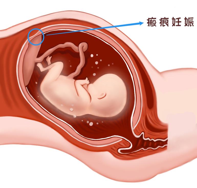 瘢痕妊娠是个啥？