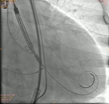 南方医科大学顺德医院心血管内科黎文生主任团队完成重度钙化 TYPE1 型二叶瓣 TAVR 一例