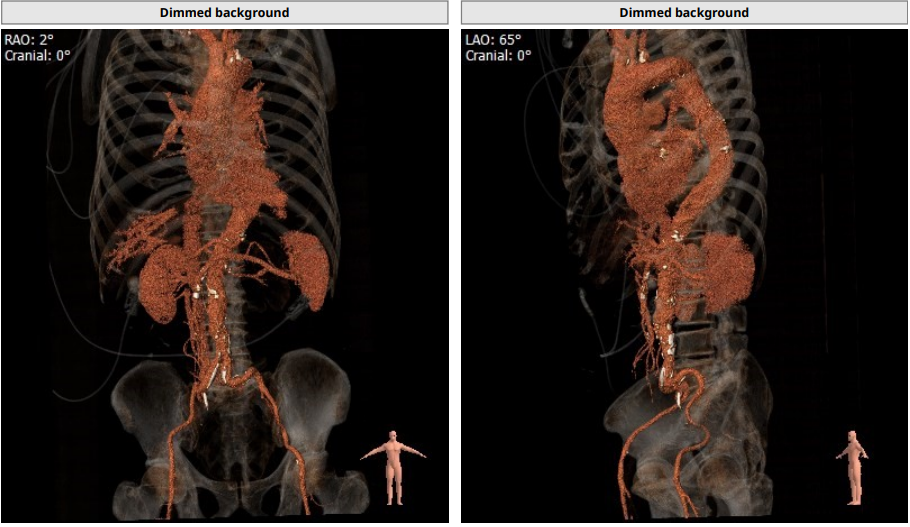 南方医科大学顺德医院心血管内科黎文生主任团队完成重度钙化 TYPE1 型二叶瓣 TAVR 一例