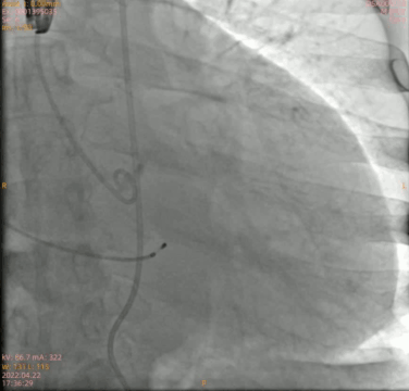 南方医科大学顺德医院心血管内科黎文生主任团队完成重度钙化 TYPE1 型二叶瓣 TAVR 一例