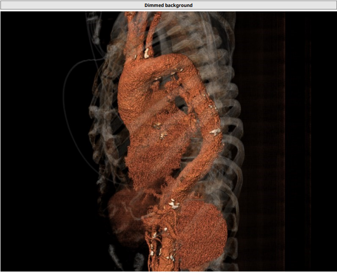 南方医科大学顺德医院心血管内科黎文生主任团队完成重度钙化 TYPE1 型二叶瓣 TAVR 一例