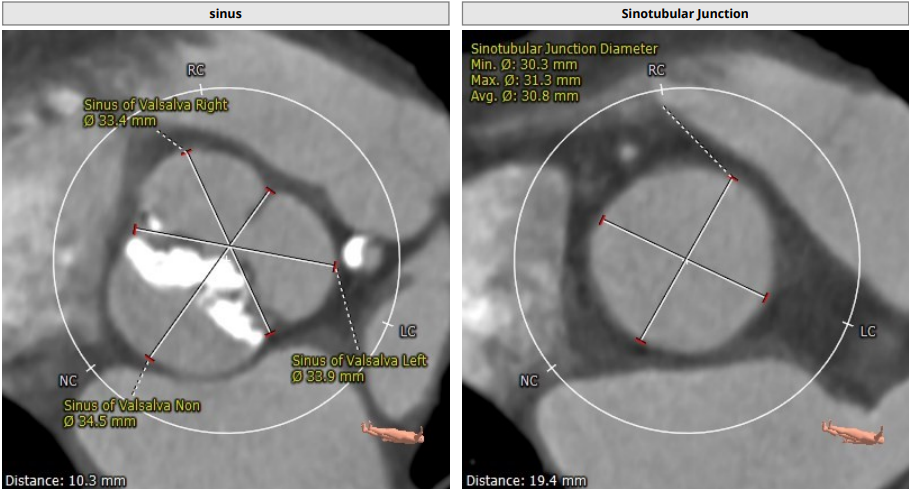 南方医科大学顺德医院心血管内科黎文生主任团队完成重度钙化 TYPE1 型二叶瓣 TAVR 一例