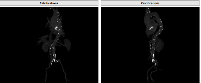 南方医科大学顺德医院心血管内科黎文生主任团队完成重度钙化 TYPE1 型二叶瓣 TAVR 一例