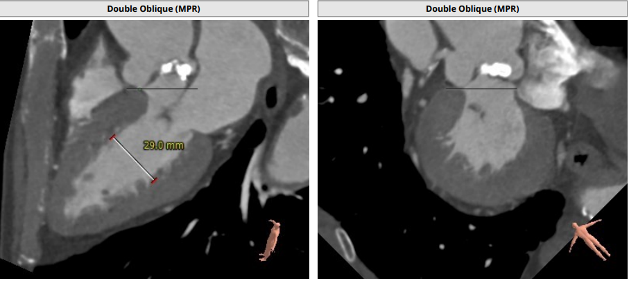 南方医科大学顺德医院心血管内科黎文生主任团队完成重度钙化 TYPE1 型二叶瓣 TAVR 一例
