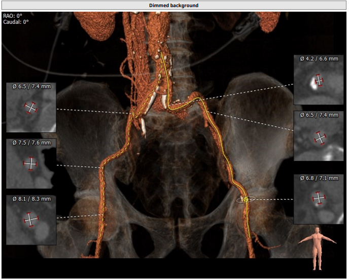 南方医科大学顺德医院心血管内科黎文生主任团队完成重度钙化 TYPE1 型二叶瓣 TAVR 一例