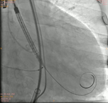 南方医科大学顺德医院心血管内科黎文生主任团队完成重度钙化 TYPE1 型二叶瓣 TAVR 一例